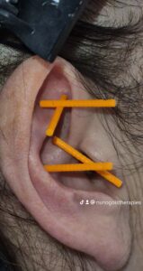 Auricular acupuncture NADA protocol ear treatment for stress and anxiety support
